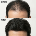 Before and after hairline